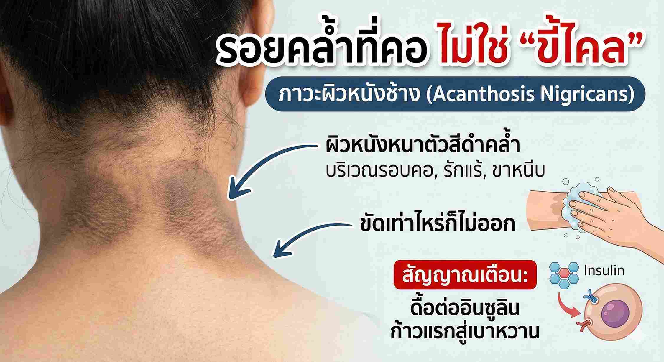 รอยคล้ำที่คอไม่ใช่ขี้ไคล